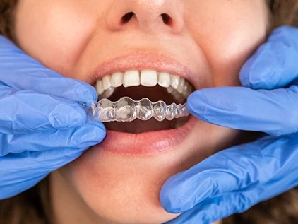 Dentista en ciudad real solucionando Bruxismo