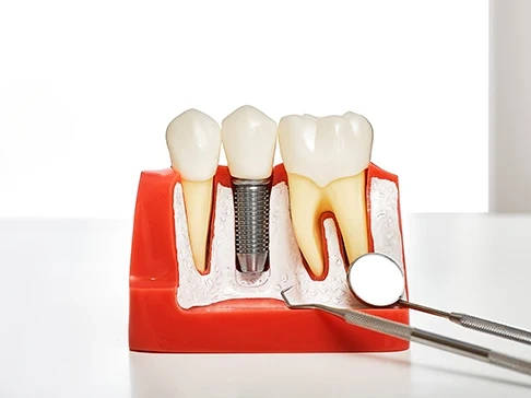 Imagen de un implante dental en ciudad real
